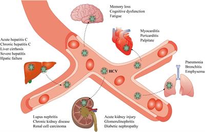 Understanding the relationship between HCV infection and progression of kidney disease